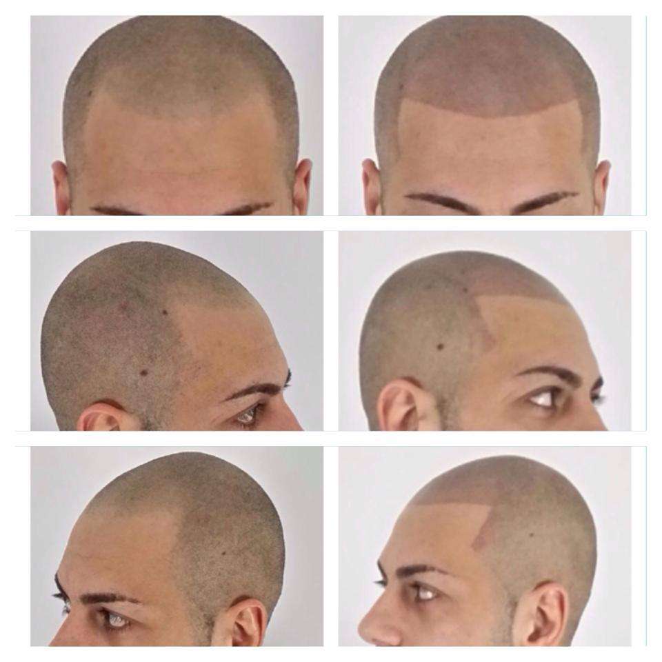 Scalp Micro Pigmentation Bali Scalp Micropigmentation In Indonesia